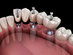 Fest verschraubte Brücke auf Implantaten