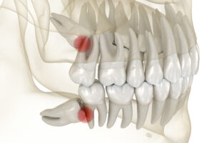 Mesial impaction of Wisdom teeth. Medically accurate tooth 3D illustration